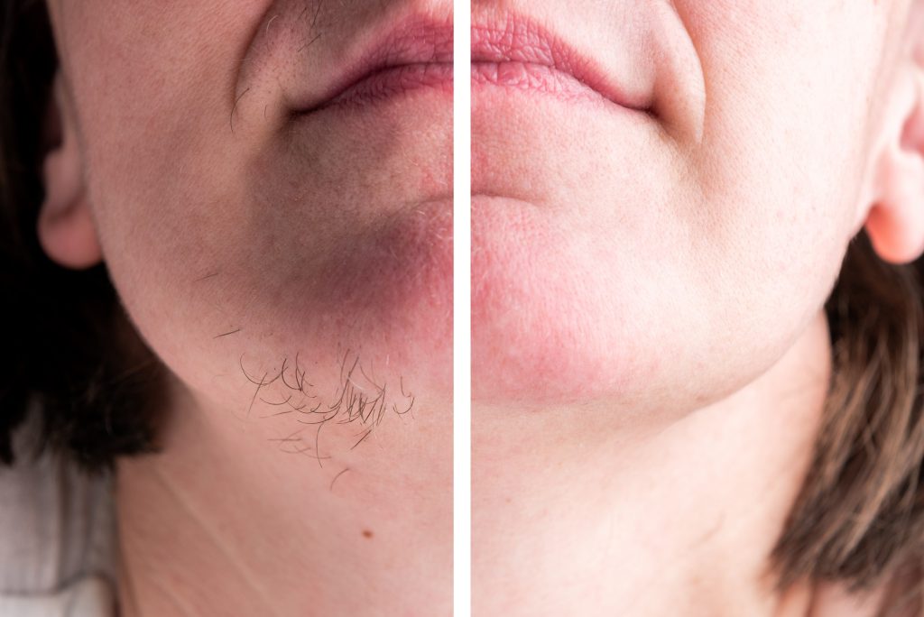 "Prim-plan al bărbiei unei femei, arătând o comparație înainte și după tratamentul pentru hirsutism.